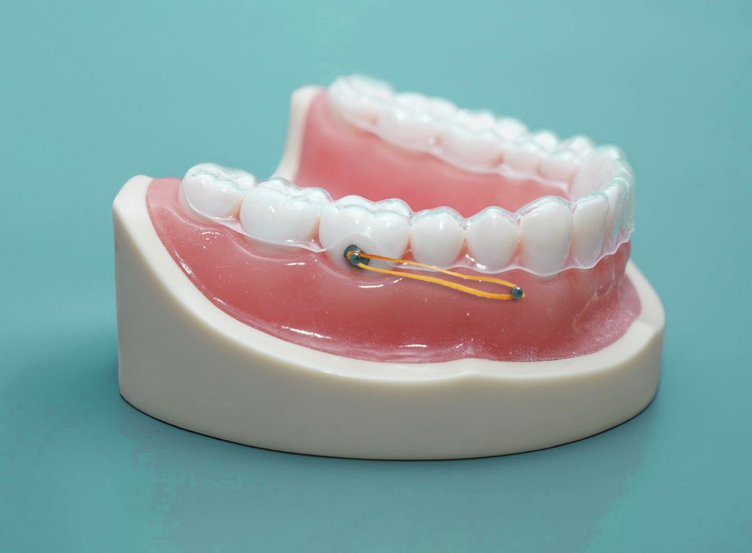 Class 3 malocclusion treatment with clear aligners treatment plan